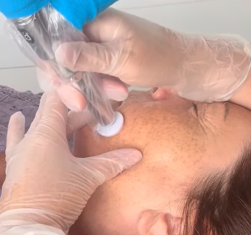 Microchanneling (Microneedling)