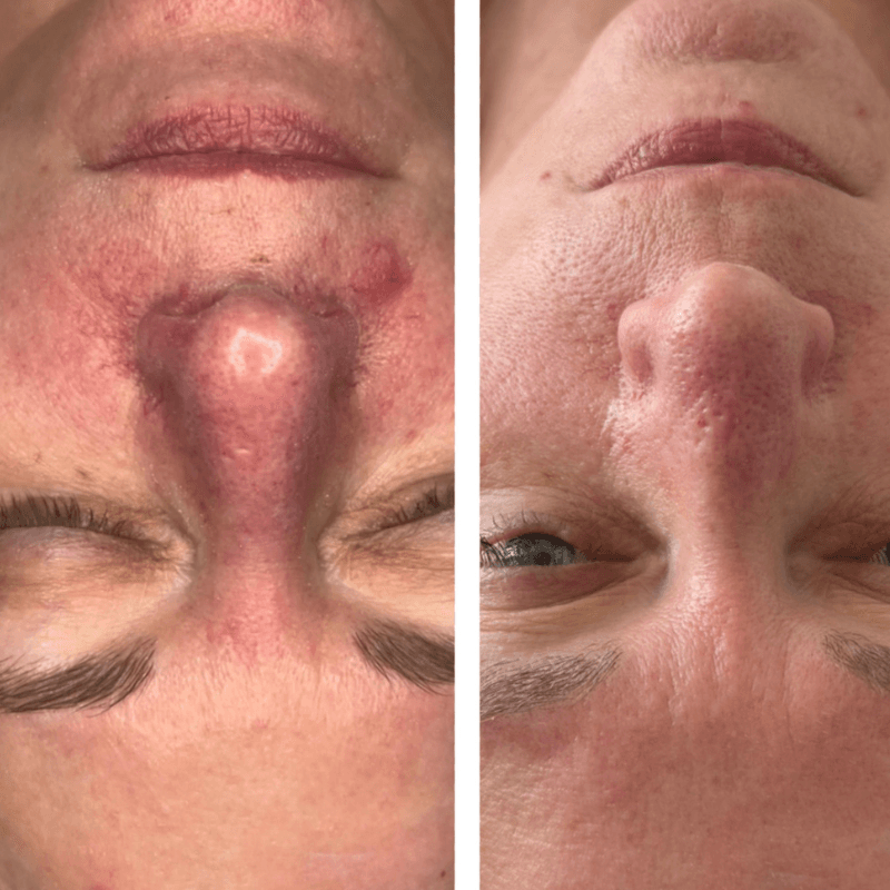 Thesera G (Bio Microneedling)