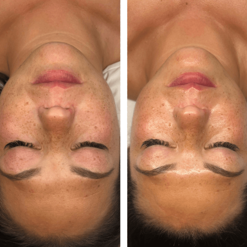 Thesera H (Glass Skin)