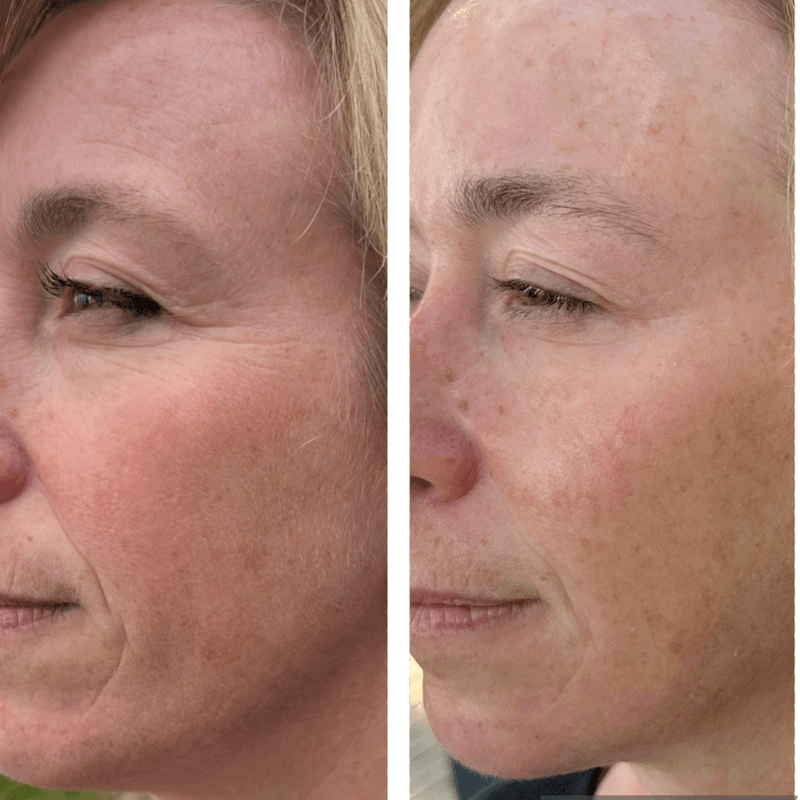 Thesera L (Melting Thread Lift)