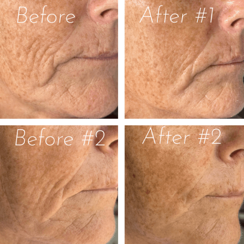 Before and after: Wrinkle Reduction & Firmness